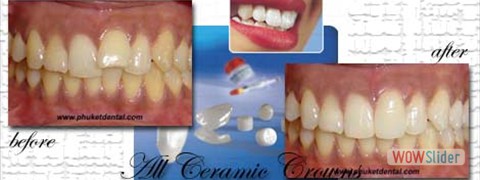 all ceramic crown01