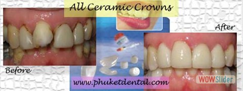 all ceramic crown07