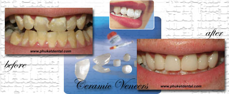 Ceramic/Porcelain Veneers by Phuket Dentist at Phuket Dental Clinic in Phuket,Thailand