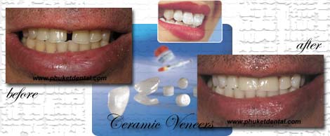Ceramic/Porcelain Veneers by Phuket Dentist at Phuket Dental Clinic in Phuket,Thailand