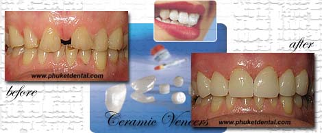 Ceramic/Porcelain Veneers by Phuket Dentist at Phuket Dental Clinic in Phuket,Thailand