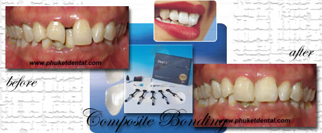 Composite Bonding by Phuket Dentist at Phuket Dental Clinic in Phuket,Thailand