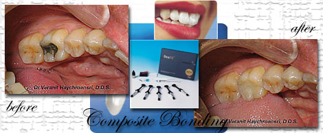 Adhesive/Direct Composite Bonding