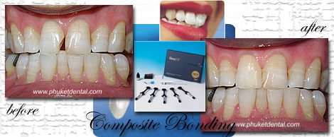 Composite Bonding by Phuket Dentist at Phuket Dental Clinic in Phuket,Thailand