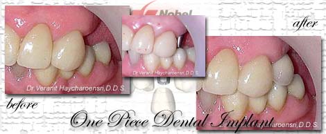 dental implant