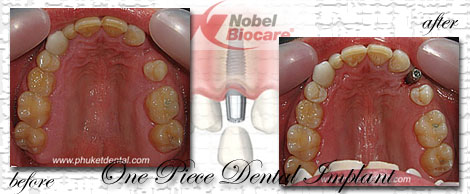 Dental Implants by Phuket Dentist at Phuket Dental Clinic in Phuket,Thailand