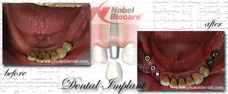 Dental Implants by Phuket Dentist at Phuket Dental Clinic in Phuket,Thailand