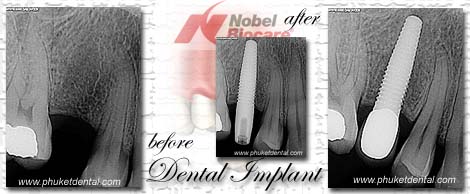 dental implant