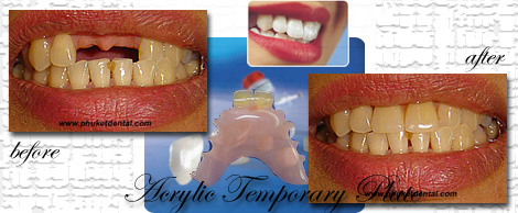 Temporary Plate/Dental flipper:Phuket Dental clinic in Thailand