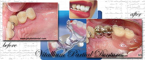 vitallium partial denture:Phuket Dental clinic,Thailand