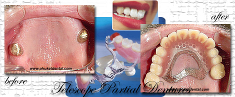 vitallium partial denture:Phuket Dental clinic,Thailand