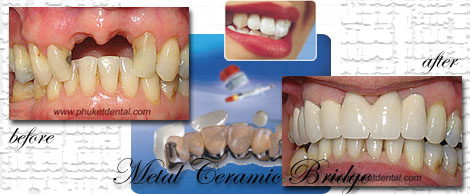 Titanium/ceramic crowns&bridges