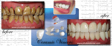 Smile Makeovers by Phuket Dentist at Phuket Dental Clinic in Phuket,Thailand