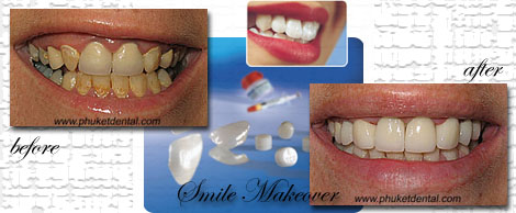 http://www.phuketdental.com/pictures_clinical%20cases/01%20smile%20makeover/smile_makeover02.jpg
