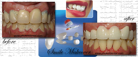 Smile Makeovers by Phuket Dentist at Phuket Dental Clinic in Phuket,Thailand