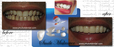 Smile Makeovers by Phuket Dentist at Phuket Dental Clinic in Phuket,Thailand