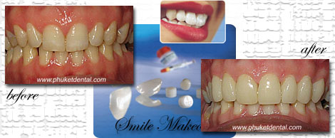Smile Makeovers by Phuket Dentist at Phuket Dental Clinic in Phuket,Thailand