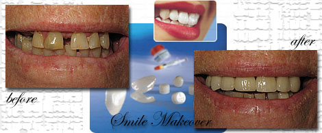 Smile Makeovers by Phuket Dentist at Phuket Dental Clinic in Phuket,Thailand