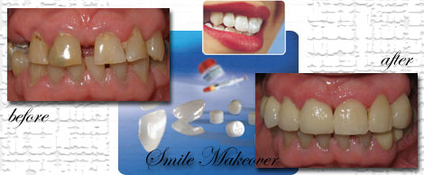 Smile Makeovers by Phuket Dentist at Phuket Dental Clinic in Phuket,Thailand