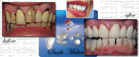 Smile Makeovers by Phuket Dentist at Phuket Dental Clinic in Phuket,Thailand