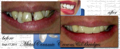 Smile Makeovers by Phuket Dentist at Phuket Dental Clinic in Phuket,Thailand