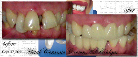 Smile Makeovers by Phuket Dentist at Phuket Dental Clinic in Phuket,Thailand