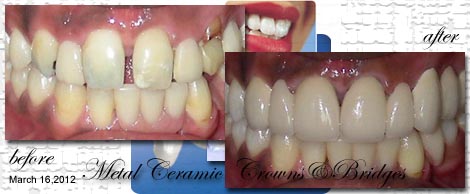 Smile Makeovers by Phuket Dentist at Phuket Dental Clinic in Phuket,Thailand