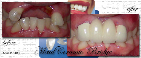 Smile Makeovers by Phuket Dentist at Phuket Dental Clinic in Phuket,Thailand