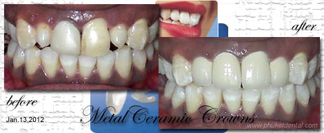 Smile Makeovers by Phuket Dentist at Phuket Dental Clinic in Phuket,Thailand