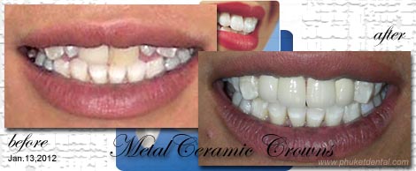 Smile Makeovers by Phuket Dentist at Phuket Dental Clinic in Phuket,Thailand