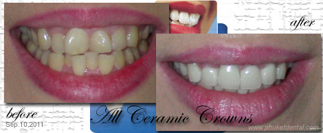 Smile Makeovers by Phuket Dentist at Phuket Dental Clinic in Phuket,Thailand