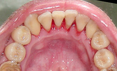 tooth cleaning