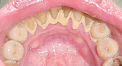 tooth cleaning
