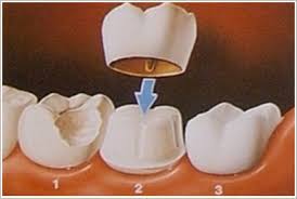 dental crown