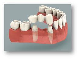 dental bridge