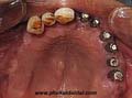 dental implant
