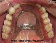 Partial Dentures with Telescope Crown Attachment