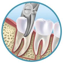 tooth extraction